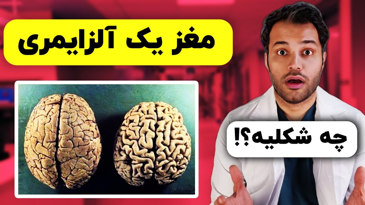 چند حقیقت درباره بیماری مخوف آلزایمر که نمیدونستید | چجوری از آلزایمر جلوگیری کنیم؟!