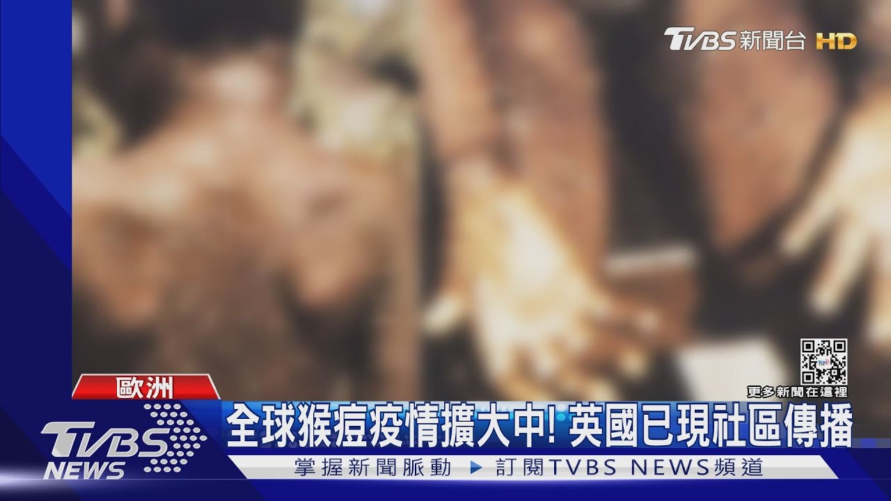全球猴痘疫情擴大中! 英國已出現社區傳播