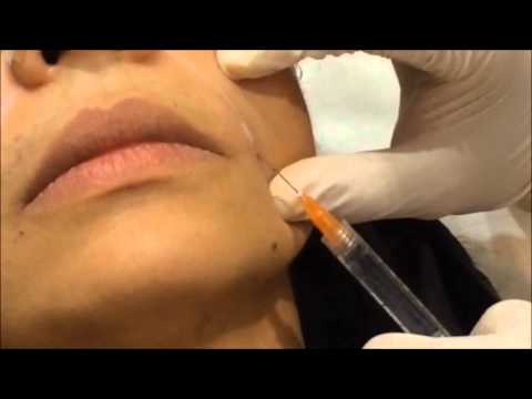 Lip filler and nasal at Hush clinic