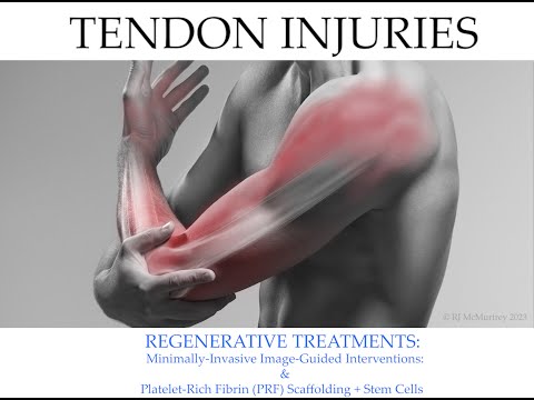 Regenerative Stem Cell Treatments for Tendon, Ligament ...