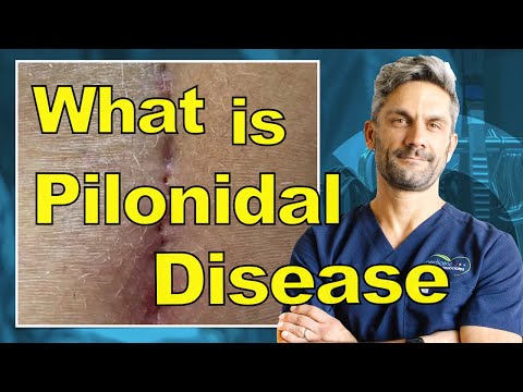 Pilonidal Cyst Disease Explained — Why It Keeps Coming Back