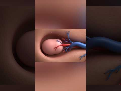 Testicular Torsion: A Medical Emergency in Motion