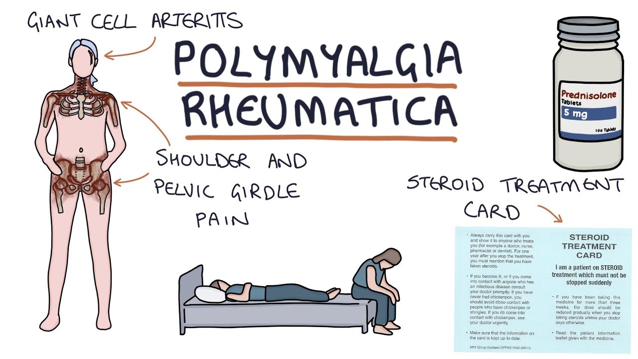 Polymyalgia Rheumatica: Visual Explanation for Students