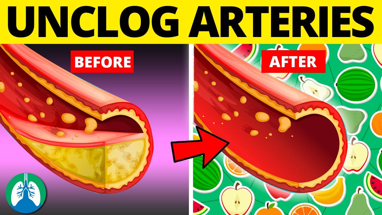 Top 10 Foods to Clean Your Arteries that Can Prevent a Heart Attack