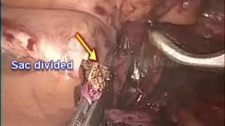 Laparoscopic Inguinal Hernia Repair (TAPP) by Dr Nitish Jhawar