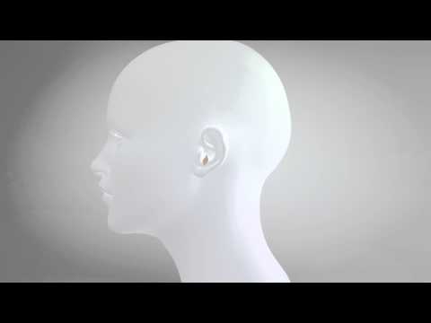 Prominent ears correction with earFold™ - How it works