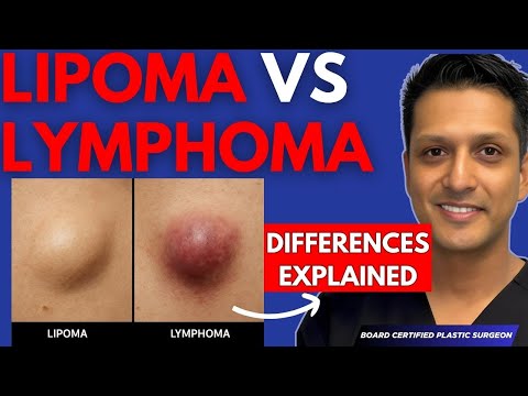Lipoma vs Lymphoma - How To Spot The Differences (one can be deadly)