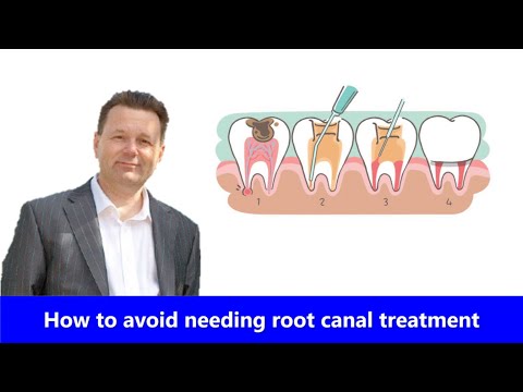 1st YouTube video about how to avoid root canal