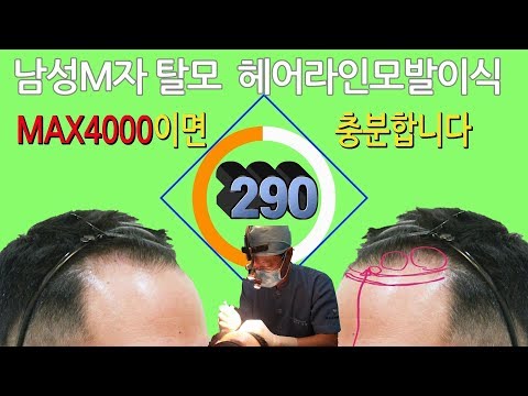 M자탈모 헤어라인모발이식 290만원의 행복 맥스4000모발이식 루트