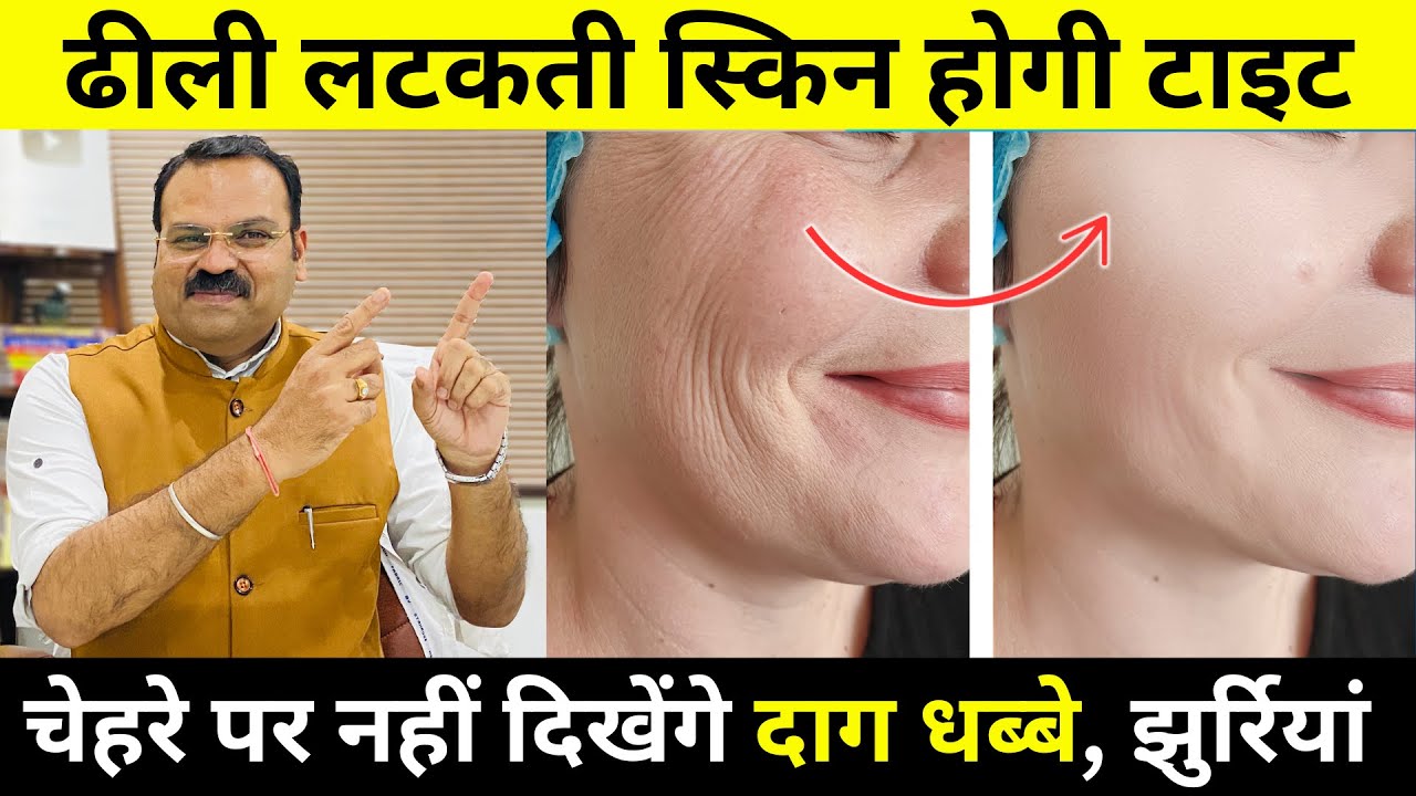 चेहरे की झुर्रियां,  दाग धब्बे, फाइन लाइंस होगी ख़त्म- चेहरा गुलाब जैसा खिल उठेगा wrinkle removal