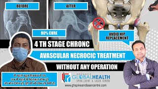 4th D-stage Avascular Necrosis Of Mr.Ashok Kumar Bunkar Repaired & Regenerated in Just 6 months