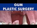 Gum plastic surgery - Laterally positioned flap for root coverage ©