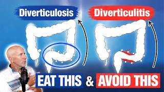 Diverticulitis: What to eat