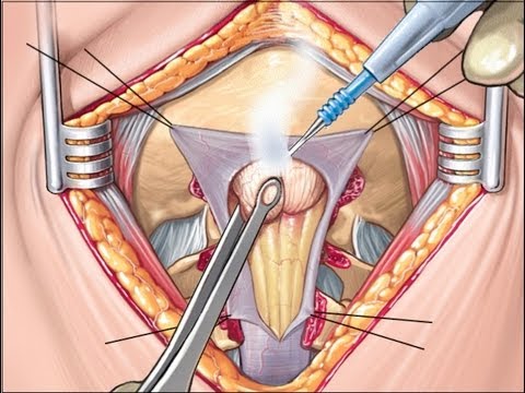Arnold-Chiari 1 Decompression