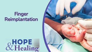 Replantation Of Finger | Treating Hand Pain Town Hall