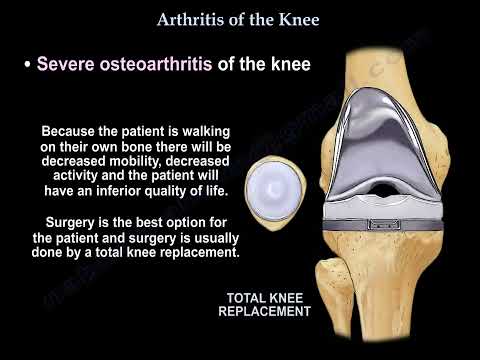 Knee Arthritis: Causes, Symptoms, Diagnosis, and Treatment Options