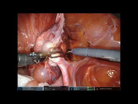 Complex Hysterectomy Made Easy Using da Vinci Robot Assisted Surgery