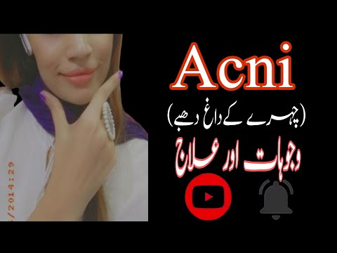 Face pa acni ka treatment||abeha abeha||