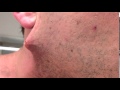 Un hombre se quita un doloroso pelo encarnado de su cara  