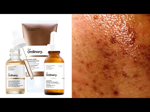 Top 5 Ordinary Skincare For Hyperpigmentation + How To Layer Them