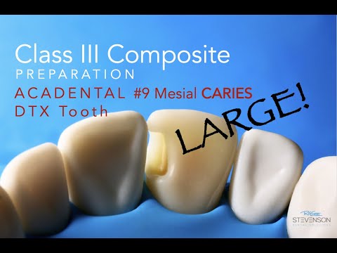 Class III Composite Preparation - EXTENSIVE CARIES - DTX #9 Mesial by Acadental