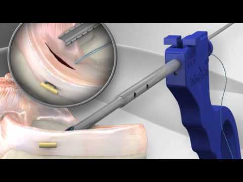 Kirurgji e Meniskut Qepje   Meniscal Cinch™