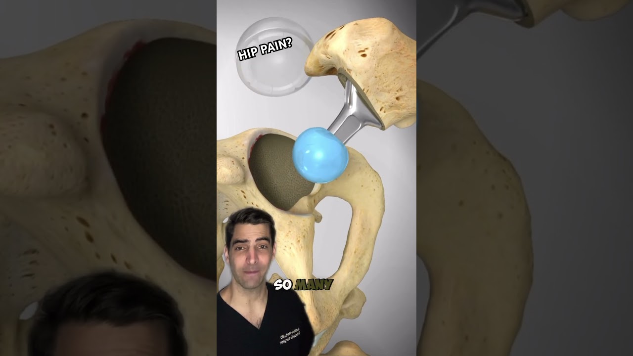 Minimally Invasive Hip Replacement