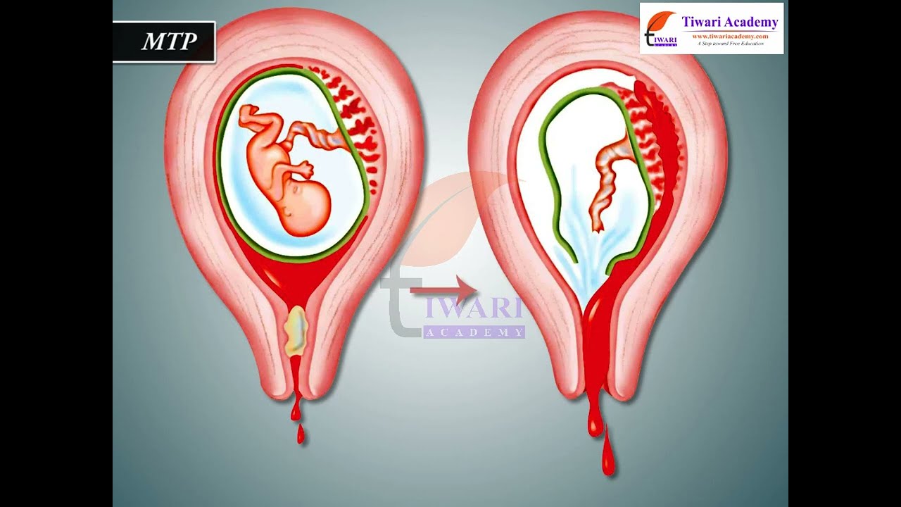 Class 12 Biology Chapter 4 Reproductive Health - Medical Termination Of Pregnancy (MTP)