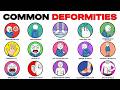 Common Deformities You Might Have Without Knowing