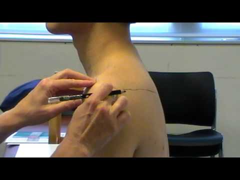 Surface Anatomy: Acromion Process