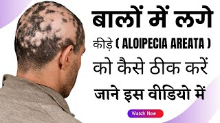 बालों में लगे कीड़े को कैसे ठीक करें | Alopecia Areata Treatment | Alopecia Areata Cure | VHCA |