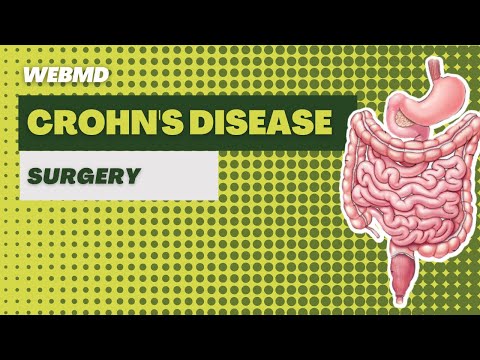 Surgery for Crohn's Disease | 3D Medical Animation | Pixeldust Studios