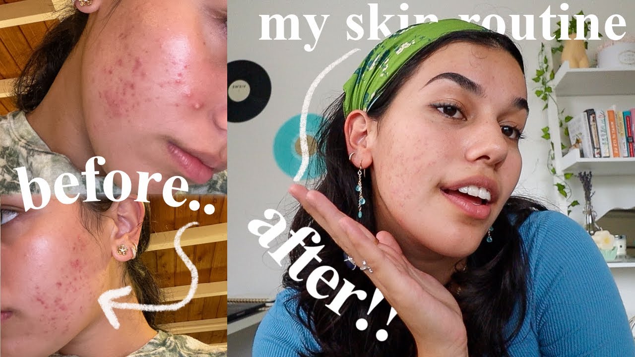 Watch video How I Cleared My Acne, skincare routine & tips!! Now How I Cleared My Acne, skincare routine & tips!!
