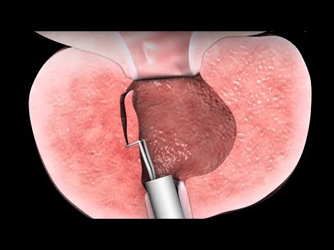 Krónikus prostatitis a népi jogorvoslatok kezelése