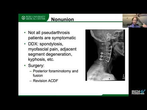 9   Revision Cervical Spine Surgery  Pseudarthrosis & Cervical Deformity   Howard S  An, MD