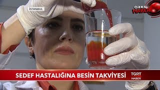 Sedef Hastalığı Kabus Olmaktan Çıkıyor