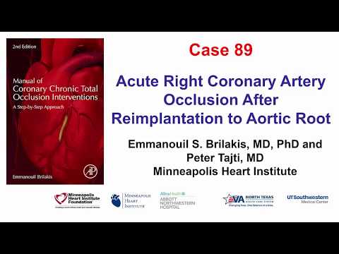 Case 89: Manual of CTO Interventions: Acute occlusion of reimplanted RCA