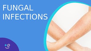 Fungal Infections - Causes, Prevention and Cure