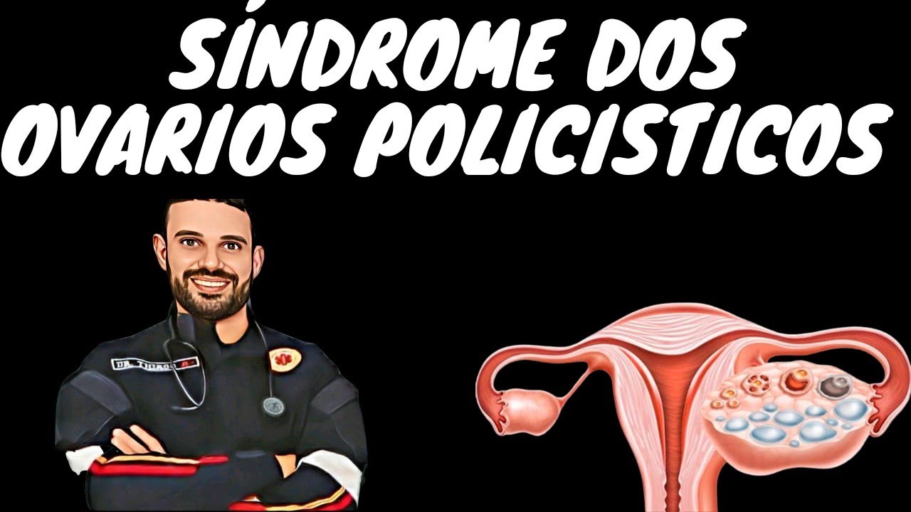 SINDROME DOS OVÁRIOS POLICÍSTICOS - SOP