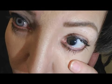 BRIGHTOCULAR GONE WRONG - PATIENT DISCUSSES BAD EXPERIENCE WITH BRIGHTOCULAR IRIS IMPLANTS