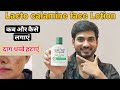 Lacto Calamine Face Lotion Honest Review How To Use Lacto Calamine Lotion लैक्टो कै�