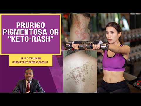 Prurigo pigmentosa or Keto-rash