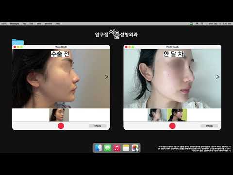 코성형 전후｜자연스러운 변화 케이스 2가지 공개