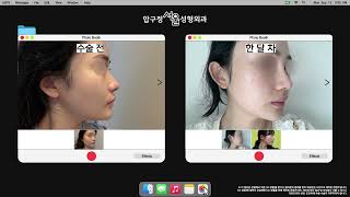 코성형 전후변화 케이스 2가지
