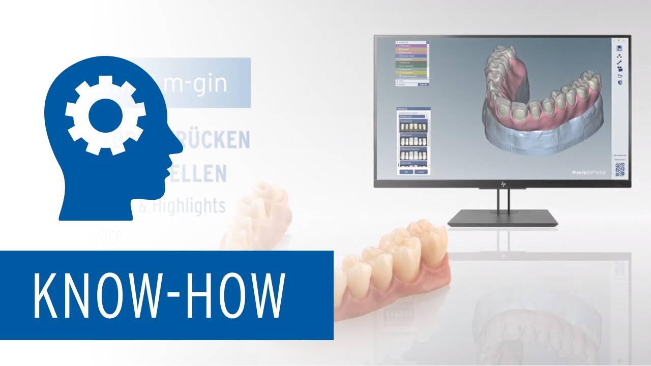 Ceramill M-Gin – Neue Features des Softwaremoduls zur digitalen Herstellung von REAX Hybrid-Brücken