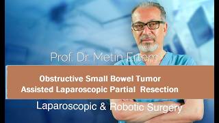 Thumbnail - Obstuctive Small Bowel Tumor. Metin Ertem MD.FACS
