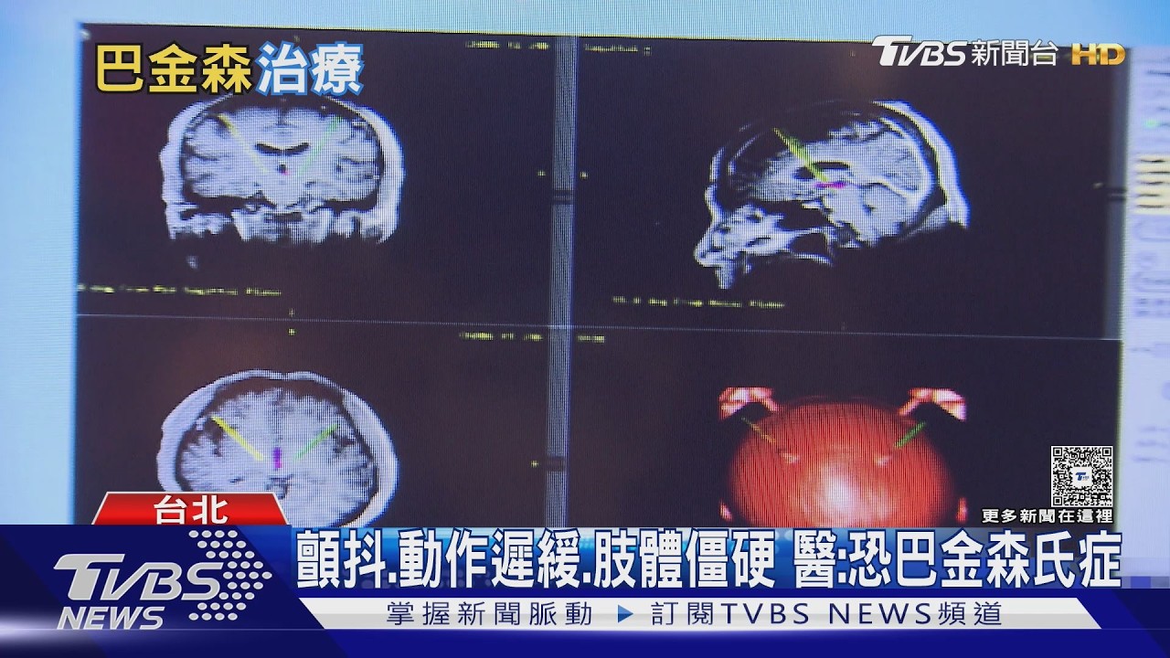 影音/巴金森氏症不只會手抖!醫揭4大典型症狀與治療關鍵