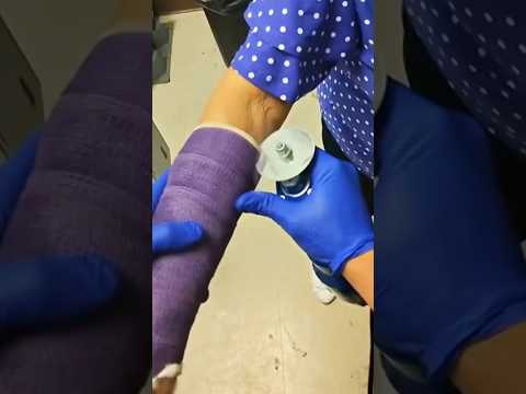 You’re Cutting Your Cast WRONG 😱🩹