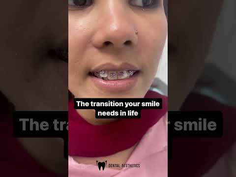 Braces On | Braces in Pakistan at Dental Aesthetics