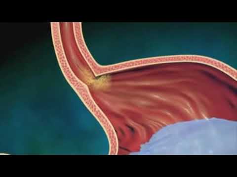 comment soigner polype gastrique estomac
